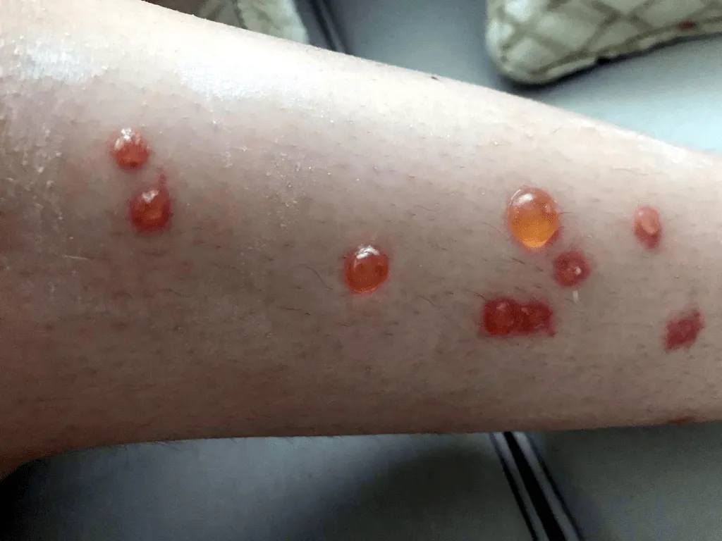 Venenos de origen animal: La cantárida